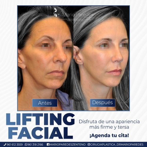 Lifting Facial